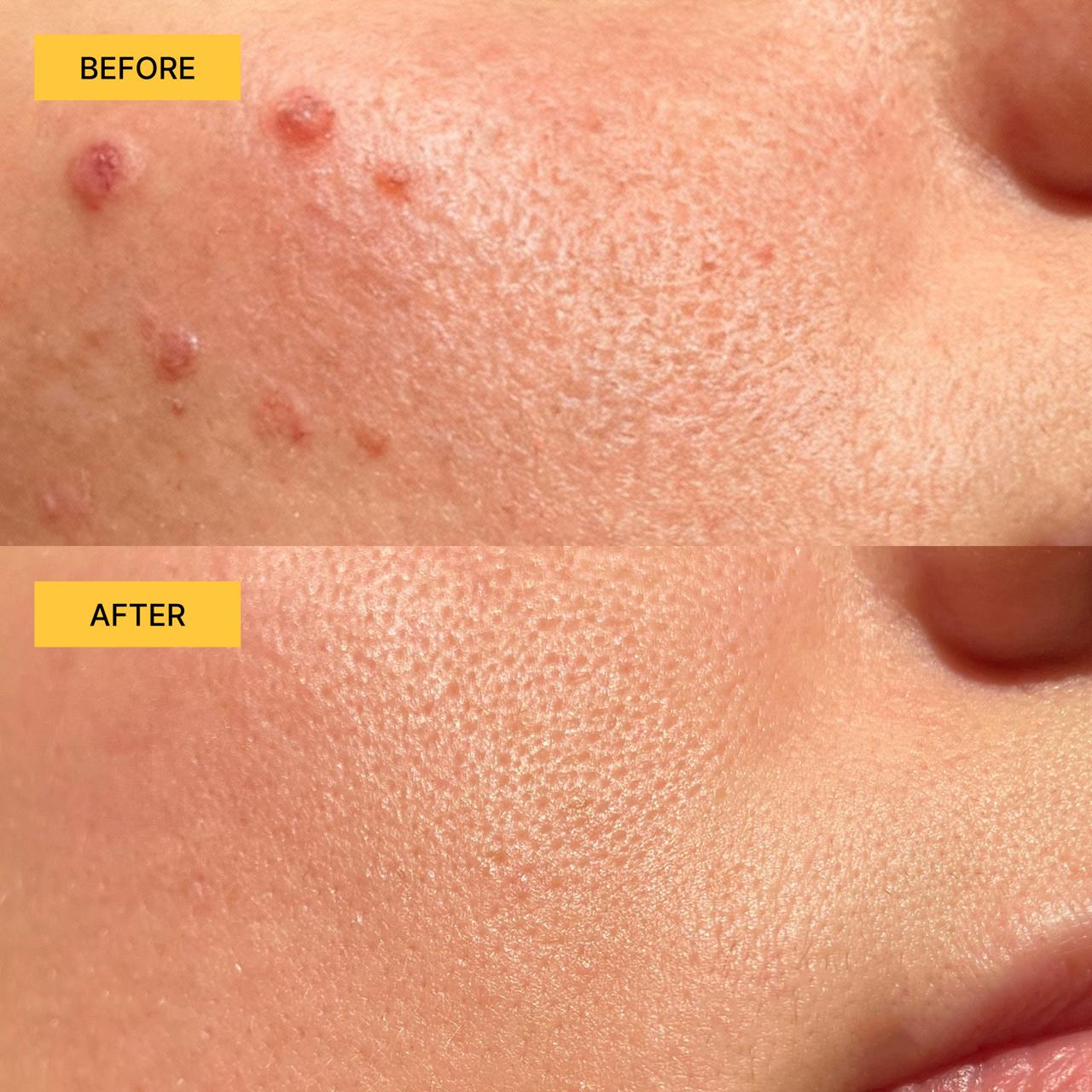 Korean Blemish Toner Pads 200mL (120 pads)