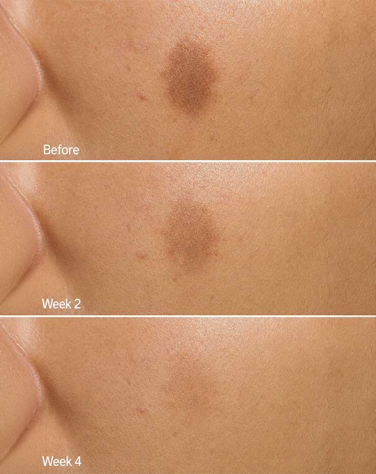 Reason 2 — fades dark spots